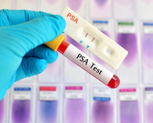Prostate Cancer Test Prostate Cancer Test